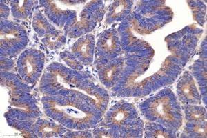 Immunohistochemistry analysis of paraffin-embedded human colon cancer using PSMD8 (ABIN7075226) at dilution of 1: 2600 (PSMD8 Antikörper)