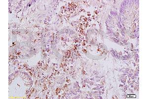 Formalin-fixed and paraffin embedded human rectal carcinoma labeled with Anti-Integrin beta 3/CD61 Polyclonal Antibody, Unconjugated (ABIN739029) at 1:200, followed by conjugation to the secondary antibody and DAB staining (Integrin beta 3 Antikörper  (AA 27-120))