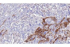 ABIN6274443 at 1/100 staining Human urothelial cancer tissue by IHC-P. (EPS8-Like 1 Antikörper  (Internal Region))
