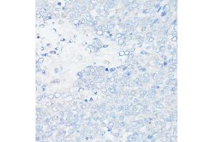 Immunohistochemistry of paraffin-embedded Human liver cancer (negative control sample) using MUC1 Rabbit mAb (ABIN7268687) at dilution of 1:100 (40x lens). (MUC1 Antikörper)