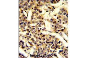 Formalin-fixed and paraffin-embedded human breast carcinoma reacted with CYP2A13 Antibody , which was peroxidase-conjugated to the secondary antibody, followed by DAB staining. (CYP2A13 Antikörper  (C-Term))