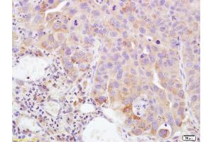 Formalin-fixed and paraffin embedded human bladder carcinoma labeled with Rabbit Anti PTGEs Polyclonal Antibody, Unconjugated (ABIN735788) at 1:200 followed by conjugation to the secondary antibody and DAB staining (Prostaglandin E Synthase Antikörper  (AA 85-152))