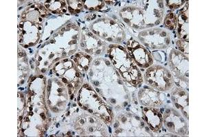 Immunohistochemical staining of paraffin-embedded Carcinoma of liver tissue using anti-GBE1 mouse monoclonal antibody. (GBE1 Antikörper)