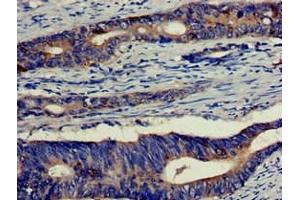 Immunohistochemistry of paraffin-embedded human colon cancer using ABIN7152180 at dilution of 1:100 (EIF4B Antikörper  (AA 362-590))