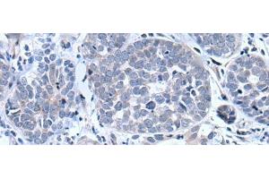 Immunohistochemistry of paraffin-embedded Human esophagus cancer tissue using BTG4 Polyclonal Antibody at dilution of 1:55(x200) (BTG4 Antikörper)