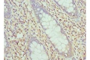 Immunohistochemistry of paraffin-embedded human colon cancer using ABIN7158340 at dilution of 1:100 (LIMS1 Antikörper  (AA 1-325))