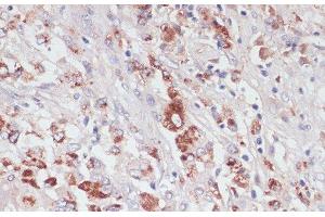 Immunohistochemistry of paraffin-embedded Human liver cancer using LYZ Polyclonal Antibody at dilution of 1:100 (40x lens). (LYZ Antikörper)