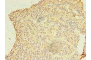 Immunohistochemistry of paraffin-embedded human breast cancer using ABIN7174932 at dilution of 1:100 (CFAP92/KIAA1257 Antikörper  (AA 1-297))