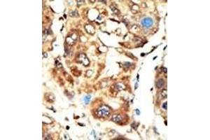 Formalin-fixed and paraffin-embedded human cancer tissue reacted with the primary antibody, which was peroxidase-conjugated to the secondary antibody, followed by AEC staining. (MAGI1 Antikörper  (C-Term))