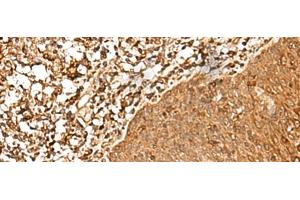 Immunohistochemistry of paraffin-embedded Human esophagus cancer tissue using FAM50A Polyclonal Antibody at dilution of 1:25(x200)