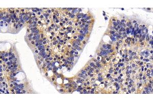 Immunohistochemistry (IHC) image for anti-Baculoviral IAP Repeat-Containing 5 (BIRC5) (AA 1-142) antibody (ABIN7426451)