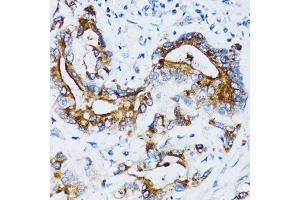 Immunohistochemistry of paraffin-embedded human colon carcinoma using MMP7 antibody.