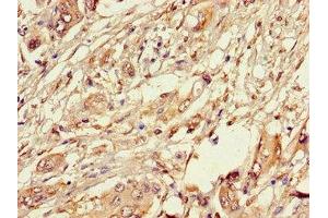 Immunohistochemistry of paraffin-embedded human pancreatic cancer using ABIN7162891 at dilution of 1:100 (PLIN3 Antikörper  (AA 192-324))