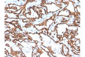 Formalin-fixed, paraffin-embedded human angiosarcoma stained with CD31 Mouse Monoclonal Antibody (PECAM1/3529). (CD31 Antikörper  (AA 625-738))