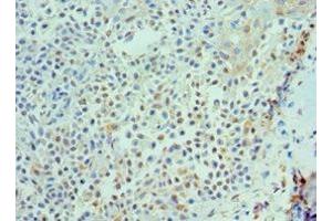 Immunohistochemistry of paraffin-embedded human breast cancer using ABIN7156850 at dilution of 1:100 (IL-21 Antikörper  (AA 25-162))