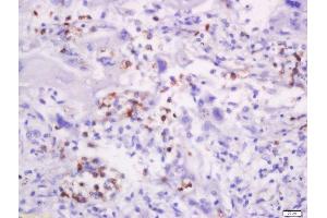 Formalin-fixed and paraffin embedded human lung carcinoma labeled with Anti-CD58/LFA-3 Polyclonal Antibody, Unconjugated  at 1:200 followed by conjugation to the secondary antibody and DAB staining. (CD58 Antikörper  (AA 31-130))