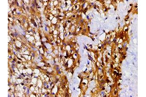 ABIN6267443 at 1/200 staining human meningeal carcinomatosis(MC) tissue sections by IHC-P.