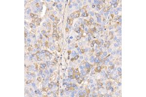 Immunohistochemistry of paraffin-embedded human liver cancer using RA/B Rabbit mAb (ABIN7269790) at dilution of 1:100 (40x lens). (RAB11A Antikörper)