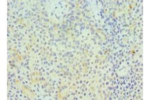 Immunohistochemistry of paraffin-embedded human breast cancer using ABIN7154414 at dilution of 1:100 (GZMA Antikörper  (AA 29-262))
