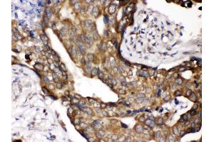 Anti- POR Picoband antibody,IHC(P) IHC(P): Human Mammary Cancer Tissue
