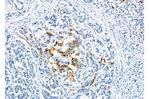 ABIN6263771 and ABIN6277122 at 1/100 staining Human pancreatic cancer and adjacent nomal tissues by IHC-P. (NUMBL Antikörper  (C-Term))