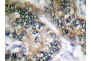 Immunohistochemistry analyzes of Separase antibody in paraffin-embedded human colon carcinoma tissue. (Separase Antikörper)