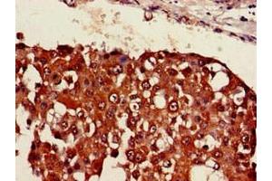Immunohistochemistry of paraffin-embedded human breast cancer using ABIN7169405 at dilution of 1:100 (SESN1 Antikörper  (AA 224-337))