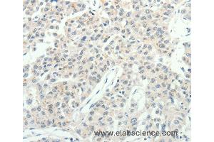 Immunohistochemistry of Human lung cancer using RPAP3 Polyclonal Antibody at dilution of 1:20 (RPAP3 Antikörper)