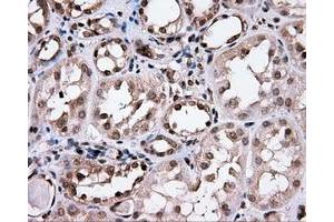 Immunohistochemical staining of paraffin-embedded Carcinoma of prostate tissue using anti-CISD1 mouse monoclonal antibody. (CISD1 Antikörper)