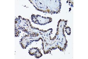Immunohistochemistry of paraffin-embedded human thyroid cancer using PRMT5 Rabbit pAb (ABIN3022065, ABIN3022066, ABIN3022067 and ABIN6218592) at dilution of 1:200 (40x lens). (PRMT5 Antikörper  (AA 40-140))