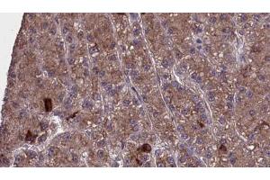 ABIN6273977 at 1/100 staining Human liver cancer tissue by IHC-P. (OR2H1 Antikörper  (C-Term))