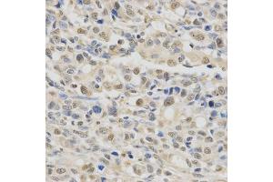 Immunohistochemistry of paraffin-embedded human gastric cancer using SPHK1 Antibody (ABIN5970017) at dilution of 1/200 (40x lens). (SPHK1 Antikörper)
