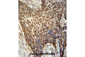 METTL4 antibody (C-term) immunohistochemistry analysis in formalin fixed and paraffin embedded human Lung carcinoma followed by peroxidase conjugation of the secondary antibody and DAB staining. (METTL4 Antikörper  (C-Term))