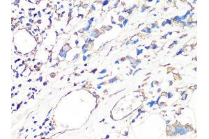 Immunohistochemistry of paraffin-embedded human breast cancer using MMP2 Antibody (ABIN4904395) at dilution of 1:100 (40x lens).