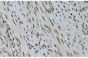 Immunohistochemistry of paraffin-embedded Human uterine cancer using LKB1 Polyclonal Antibody at dilution of 1:100 (40x lens). (LKB1 Antikörper)