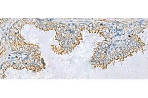 Immunohistochemistry of paraffin-embedded Human prost ate cancer tissue using PLA2G15 Polyclonal Antibody at dilution of 1:65(x200)