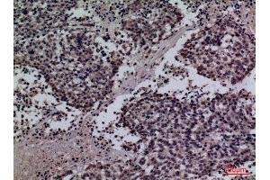 Immunohistochemistry (IHC) analysis of paraffin-embedded Human Lung Cancer, antibody was diluted at 1:100. (Surfactant Protein A1 Antikörper  (Internal Region))