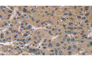 Immunohistochemistry of paraffin-embedded Human liver cancer using CYR61 Polyclonal Antibody at dilution of 1:60