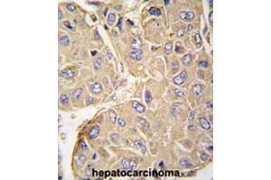 Formalin-fixed and paraffin-embedded human hepatocarcinomareacted with PTPN7 polyclonal antibody , which was peroxidase-conjugated to the secondary antibody, followed by AEC staining. (PTPN7 Antikörper  (Ser44))