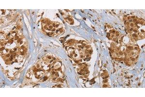 Immunohistochemistry of paraffin-embedded Human breast cancer tissue using RAB24 Polyclonal Antibody at dilution 1:45 (RAB24 Antikörper)