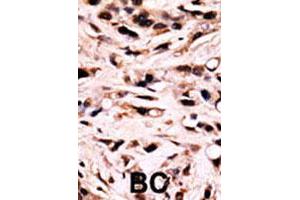 Formalin-fixed and paraffin-embedded human breast cancer tissue reacted with SMAD4 (phospho T277) polyclonal antibody  which was peroxidase-conjugated to the secondary antibody followed by DAB staining. (SMAD4 Antikörper  (Thr277))