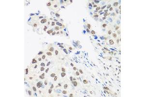 Immunohistochemistry of paraffin-embedded human prostate cancer using DDX39B antibody at dilution of 1:100 (40x lens). (DDX39B Antikörper)
