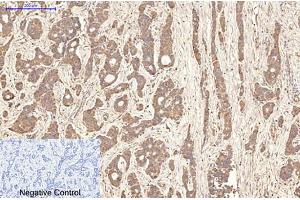 Immunohistochemical analysis of paraffin-embedded human liver cancer tissue. (Aquaporin 4 Antikörper)