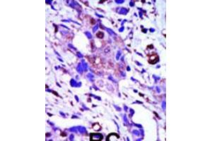 Formalin-fixed and paraffin-embedded human cancer tissue reacted with the primary antibody, which was peroxidase-conjugated to the secondary antibody, followed by AEC staining. (PLK1 Antikörper  (C-Term))