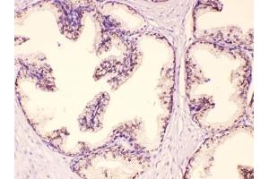 IHC testing of FFPE human prostate cancer tissue with GAA antibody at 1ug/ml. (GAA Antikörper  (AA 494-527))