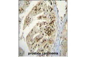 P Antibody (Center) (ABIN655637 and ABIN2845116) immunohistochemistry analysis in formalin fixed and raffin embedded human prostate carcinoma followed by peroxidase conjugation of the secondary antibody and DAB staining. (ACPP Antikörper  (AA 407-435))