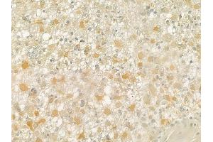 ABIN6258516 and ABIN6274735 at 1/100 staining human astrocytoma by IHC-P. (MRPL21 Antikörper  (Internal Region))