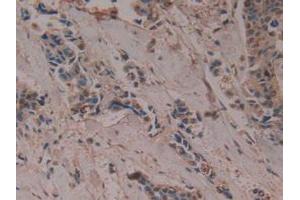 IHC-P analysis of Human Breast Cancer Tissue, with DAB staining. (PTGDS Antikörper  (AA 32-190))