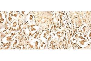 Immunohistochemistry of paraffin-embedded Human gastric cancer tissue using ZUFSP Polyclonal Antibody at dilution of 1:35(x200) (ZUFSP Antikörper)