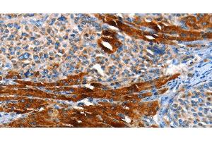 Immunohistochemistry of paraffin-embedded Human liver cancer using AOX1 Polyclonal Antibody at dilution of 1:65 (AOX1 Antikörper)